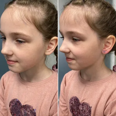 Profesjonalne przekłucie uszu dziecka z fioletowym kryształowym kolczykiem