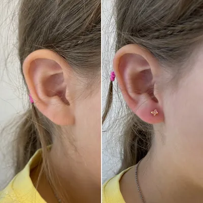 Przekłucie ucha dziecka przed i po z różowym kwiatowym kolczykiem