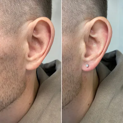 Przekłucie płatka ucha przed i po z kryształowym kolczykiem - medyczne przekłuwanie