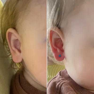 Przekłucie uszu dziecka przed i po z niebieskim kolczykiem - Inverness MED